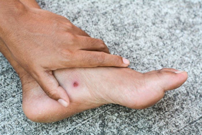 complicații ale ulcerului piciorului diabetic