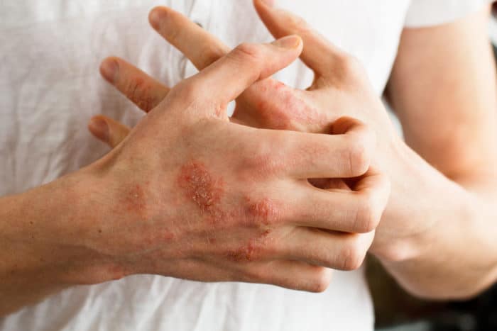 depăși eczemele în mână