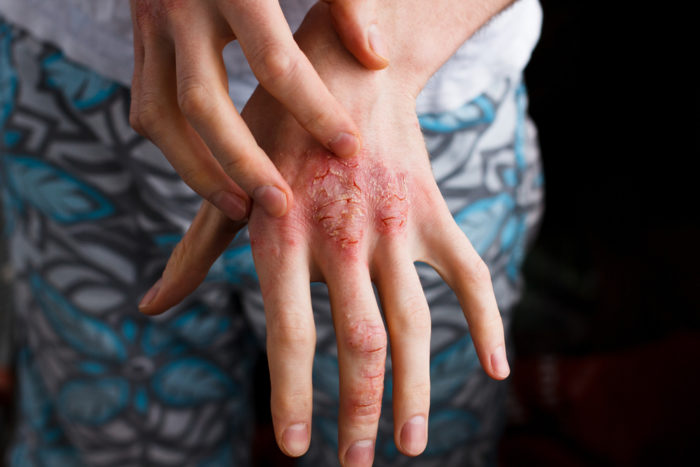 eczeme uscate și eczeme umede