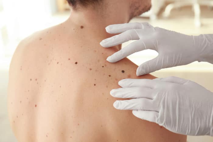 melanomul cancerului de piele