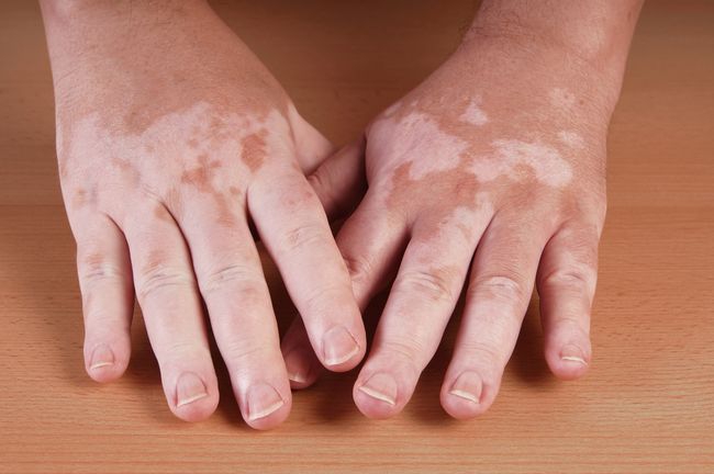 vitiligo se poate vindeca