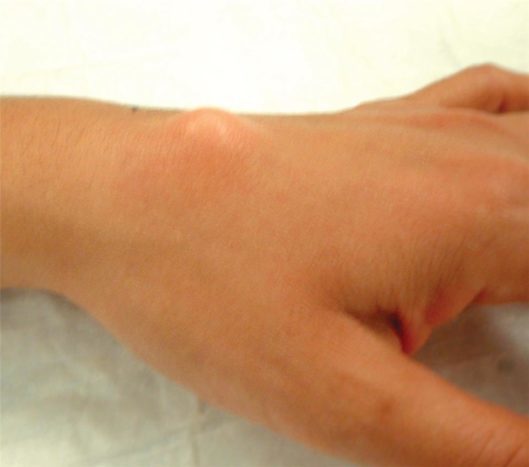Chistul ganglionului încheieturii încheieturii mâinii (sursa: Societatea Americană de Chirurgie a Mâinii)