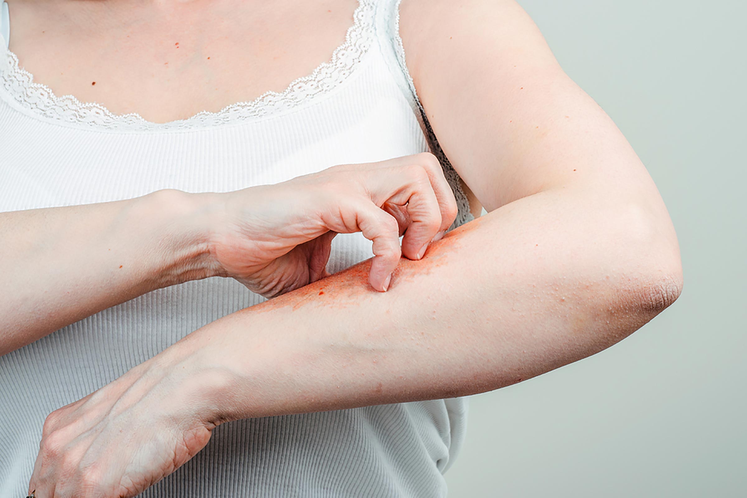 trata eczema pielii