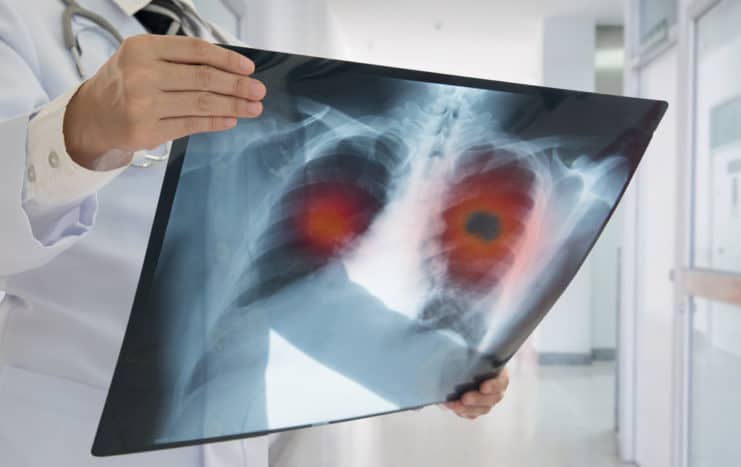 factori de risc pentru cancer pulmonar