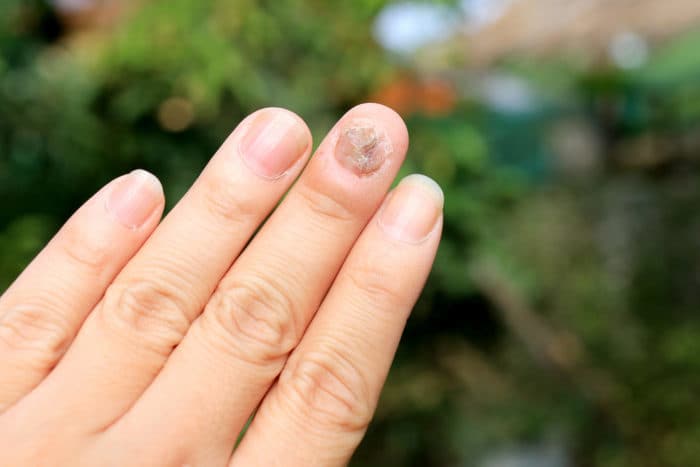 infecția fungică a unghiilor
