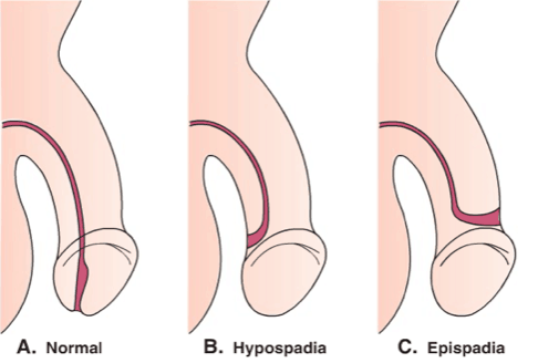 gaura penisului nu este normală, episoade de hipospadias