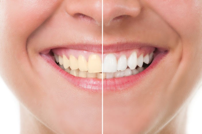 Efectele secundare ale dinților de albire cu albire