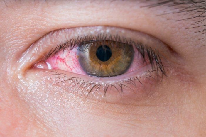 alergie conjunctivită oculară roșie