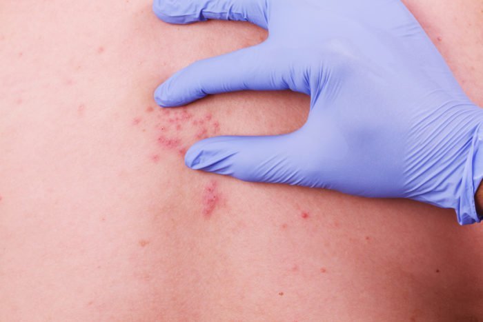 ce este sindrilele? varicela sau durerea de viermi de variola