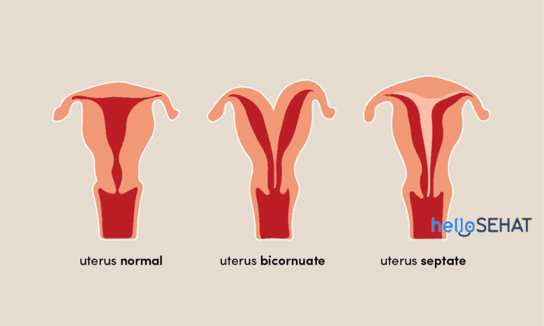 anomalii ale uterului
