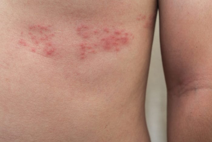 herpes zoster variola sarpe