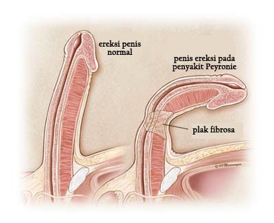 curbura penisului cauză și tratament