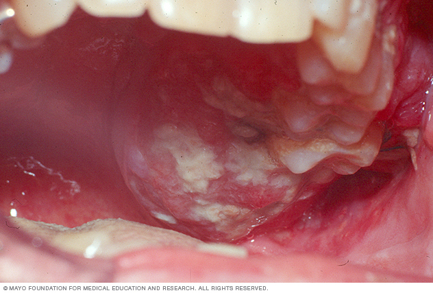 cancerul oral