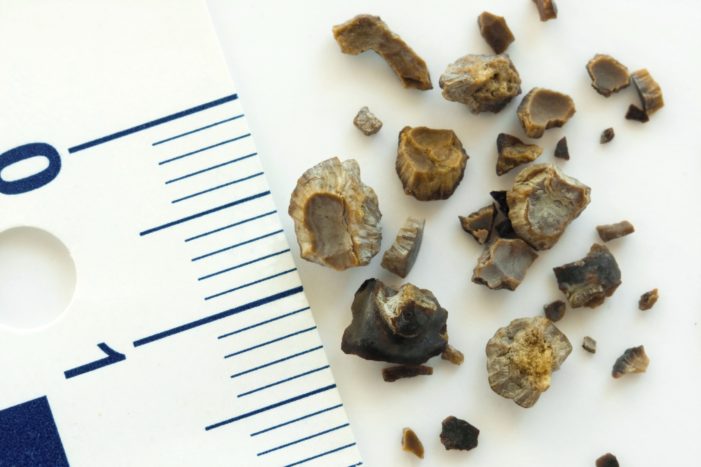 pietre la rinichi și pietre de biliară