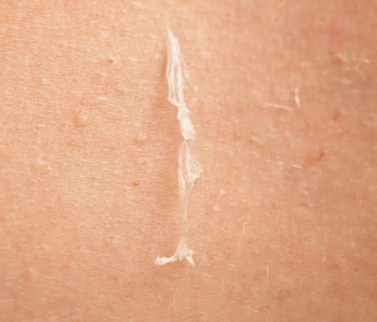 cauze de depășire a peelingului pielii