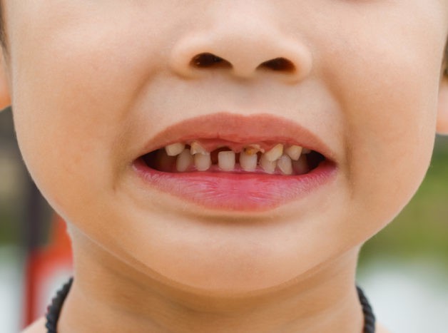 afectarea dinților copiilor