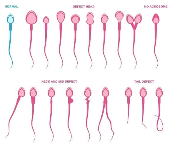 anomalii ale spermei