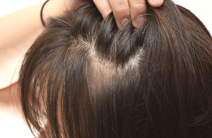 preveniți părul gri de la o vârstă fragedă